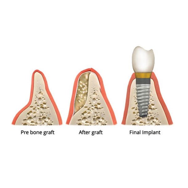 健康・医学 Implant Dentistry: Theory and Practice Dental 4 Times Implant Teeth Model Analysis Crown Bridge